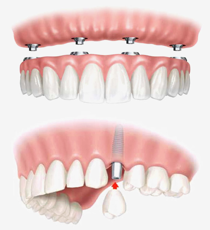 IMPLANTES IMPLANTES